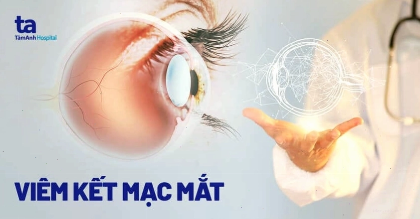 Hình ảnh minh họa tình trạng mắt bị viêm kết mạc