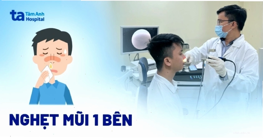 Hình ảnh minh họa tình trạng nghẹt mũi 1 bên