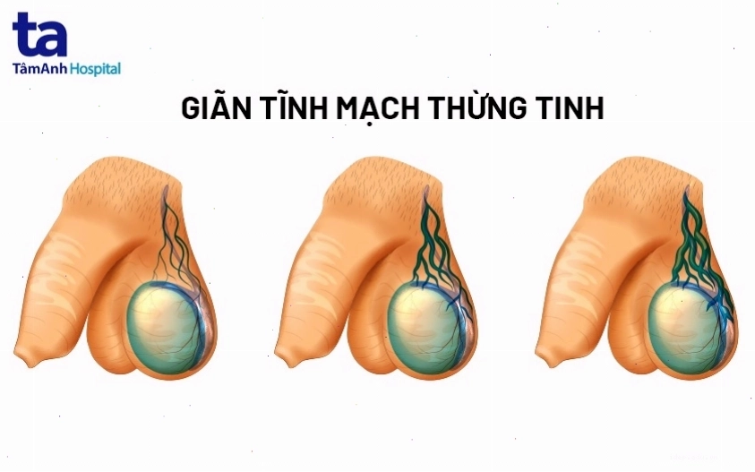 Hình ảnh minh họa tình trạng xoắn tinh hoàn