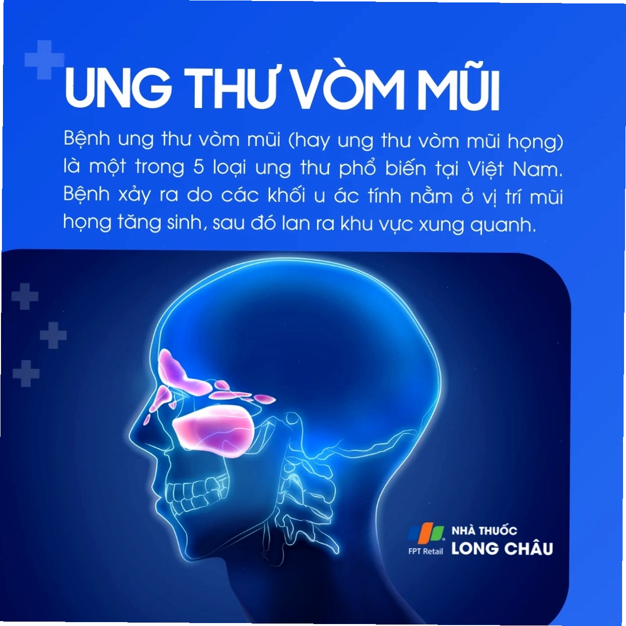 Hình ảnh minh họa triệu chứng ung thư vòm mũi