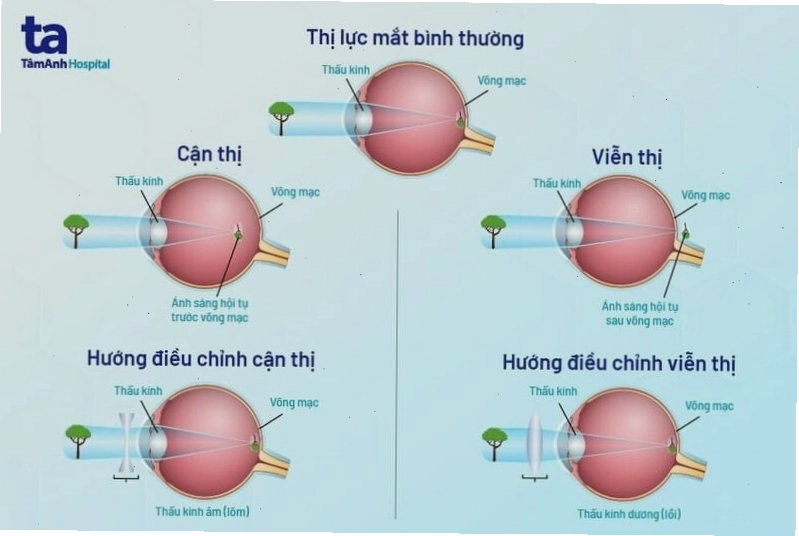 Hình ảnh minh họa về các dạng tật khúc xạ mắt phổ biến
