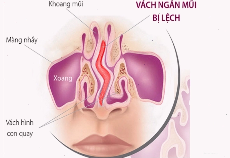 Hình ảnh mô tả tình trạng mũi lệch vách ngăn