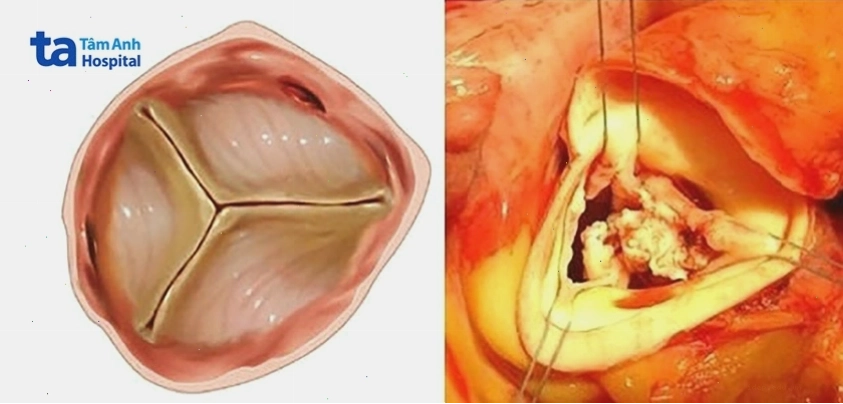 Hình ảnh sùi trên van ở bệnh nhân viêm nội tâm mạc nhiễm khuẩn