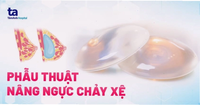 Hình ảnh trước và sau phẫu thuật nâng ngực chảy xệ