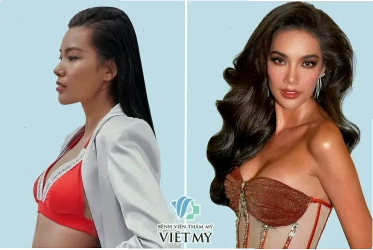 Hoa hậu Lê Hoàng Phương trước và sau khi nâng ngực