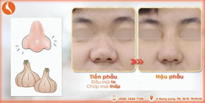 Khách hàng trước và sau khi chỉnh sửa mũi củ tỏi