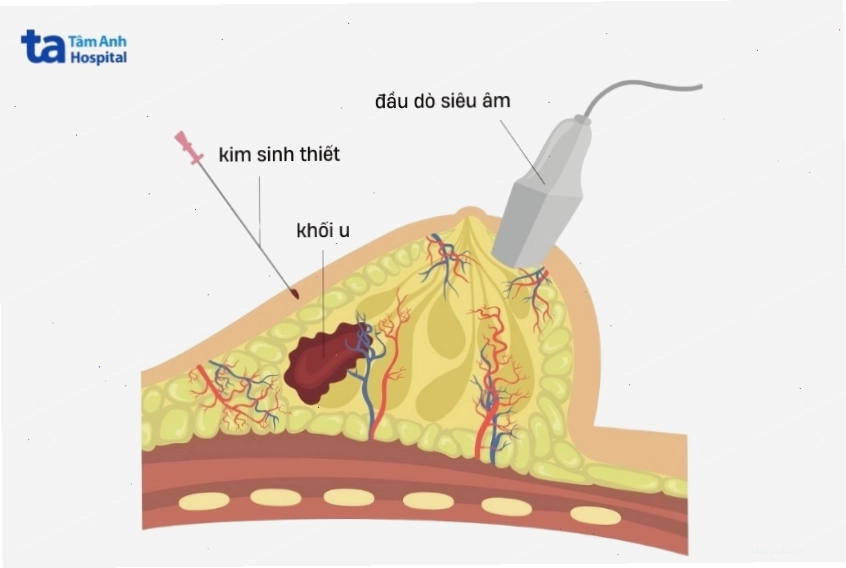 Khối u ở vú có thể gây đau khi ấn vào