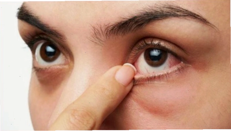 Mắt bị đỏ một bên nhưng không đau là hiện tượng phổ biến