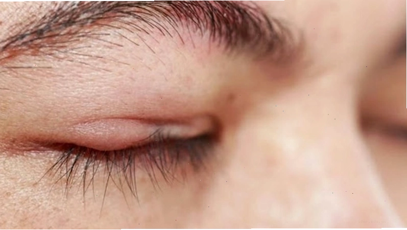 Mắt bị đỏ một bên nhưng không đau là vấn đề gì về mắt?
