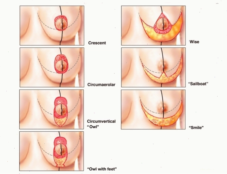 Minh họa kỹ thuật treo sa trễ ngực