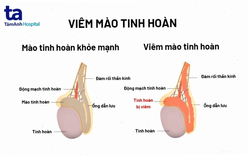 Minh họa tình trạng viêm mào tinh hoàn