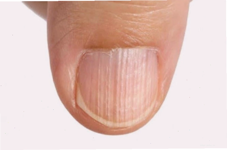 Móng tay có sọc dọc là một hiện tượng bất thường có thể do nhiều nguyên nhân
