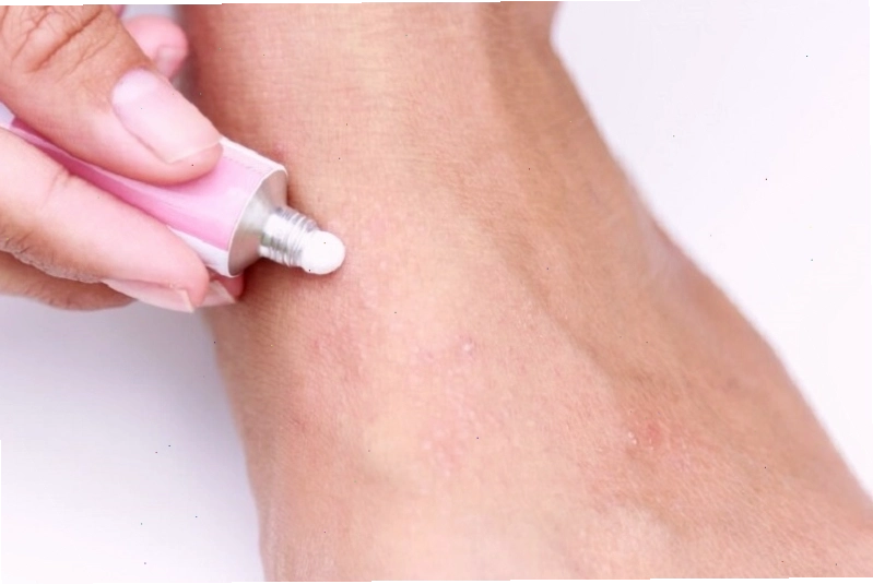 Một số trường hợp u nhú sinh dục lành tính được điều trị bằng thuốc bôi
