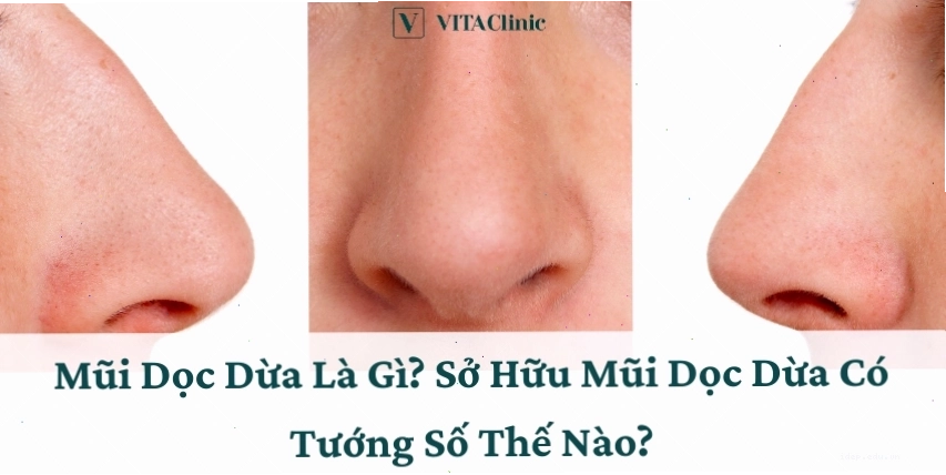 Mũi Dọc Dừa Là Gì? Sở Hữu Mũi Dọc Dừa Có Tướng Số Thế Nào? - VITA Clinic