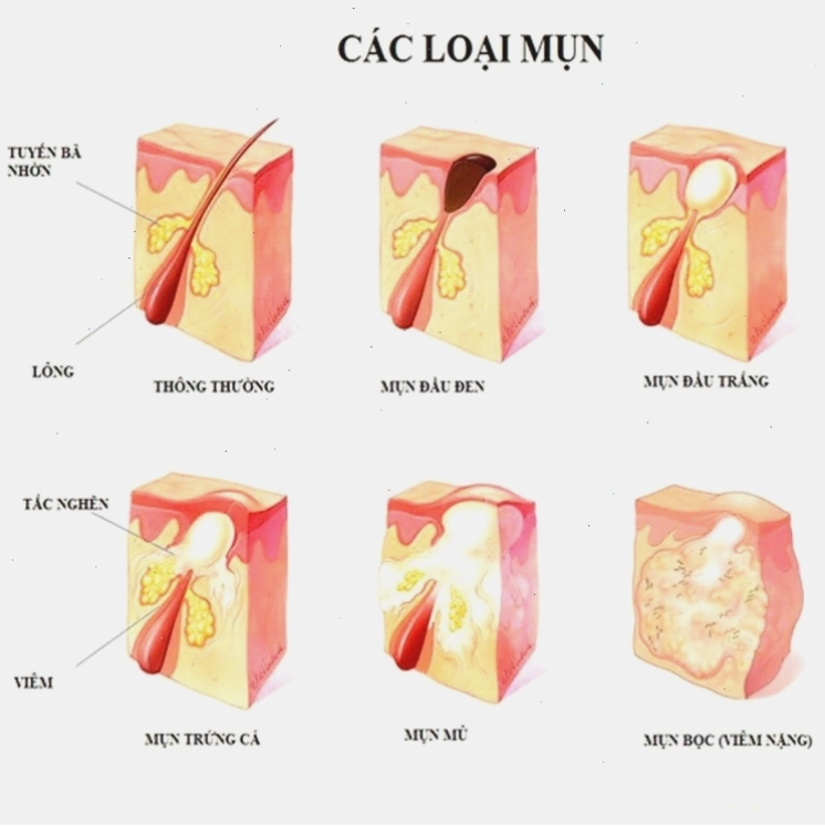 Mụn lưng có thể xuất hiện dưới nhiều dạng khác nhau như mụn đầu đen, mụn đầu trắng, mụn mủ