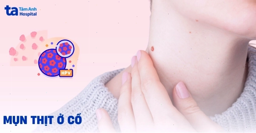 Mụn thịt cũng có thể xuất hiện ở các vùng da khác như cổ