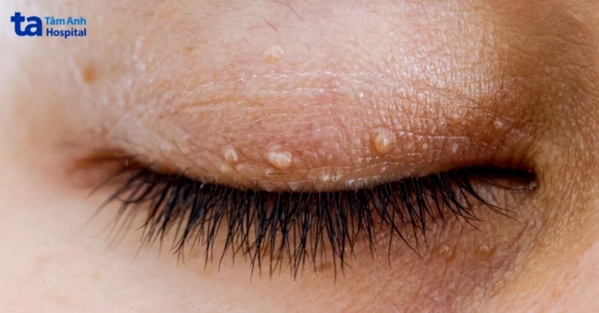 Mụn thịt ở mắt thường có kích thước nhỏ và lành tính