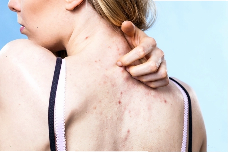 Mỹ phẩm không phù hợp hoặc kém chất lượng có thể gây tổn thương da và dẫn đến mụn lưng