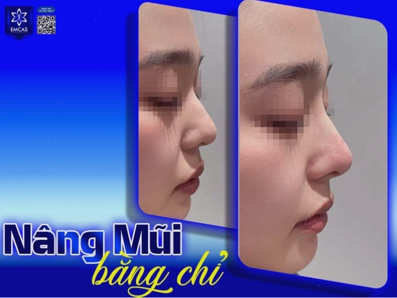 Nâng mũi bằng chỉ không phù hợp với người có nhiều khuyết điểm mũi phức tạp