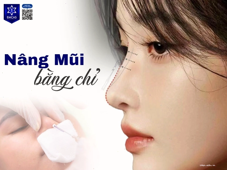 Nâng mũi bằng chỉ là thủ thuật thẩm mỹ ít xâm lấn và có tính an toàn cao