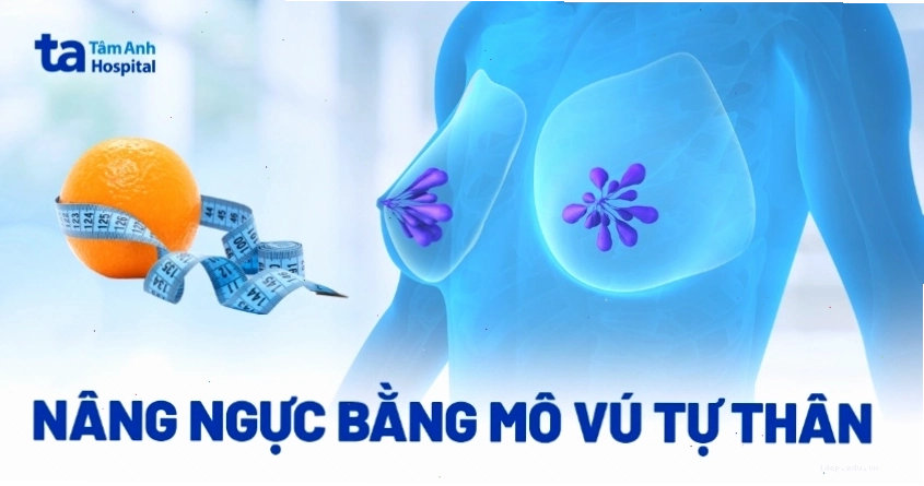 Nâng ngực bằng mỡ tự thân (vạt mô)