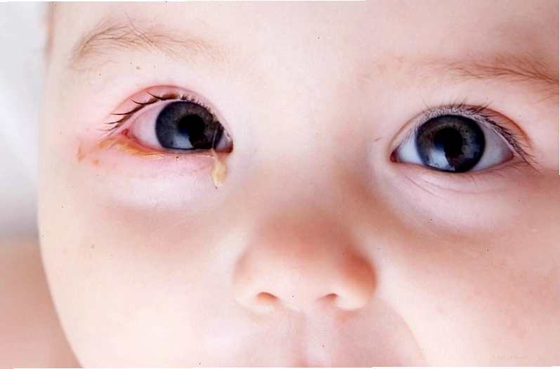 Nguyên nhân trẻ sơ sinh bị đau mắt rất đa dạng, cần theo dõi kỹ lưỡng