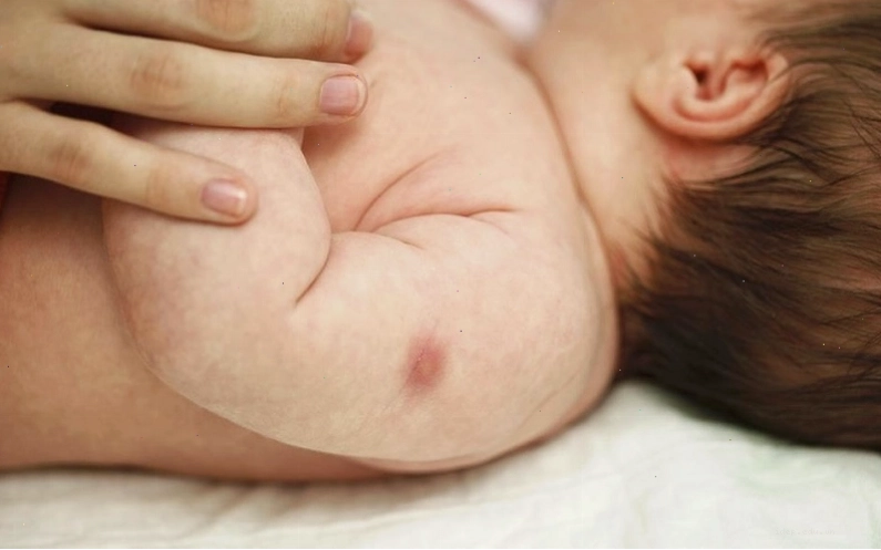 Nhiều bậc phụ huynh lo lắng trước tình trạng trẻ sơ sinh tiêm mũi lao không bị mưng mủ