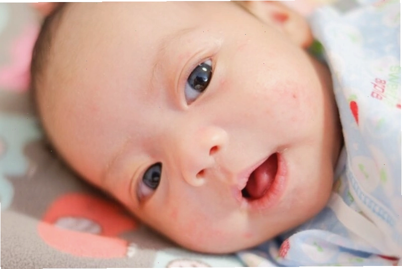 Nhiều trẻ sơ sinh bị mụn sữa nổi li ti trên mặt, chủ yếu ở hai má