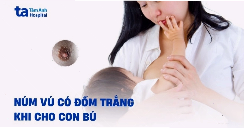 Nhũ hoa có đốm trắng