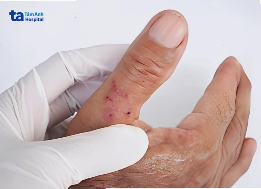 Nốt osler là một trong những triệu chứng của viêm nội tâm mạc nhiễm khuẩn