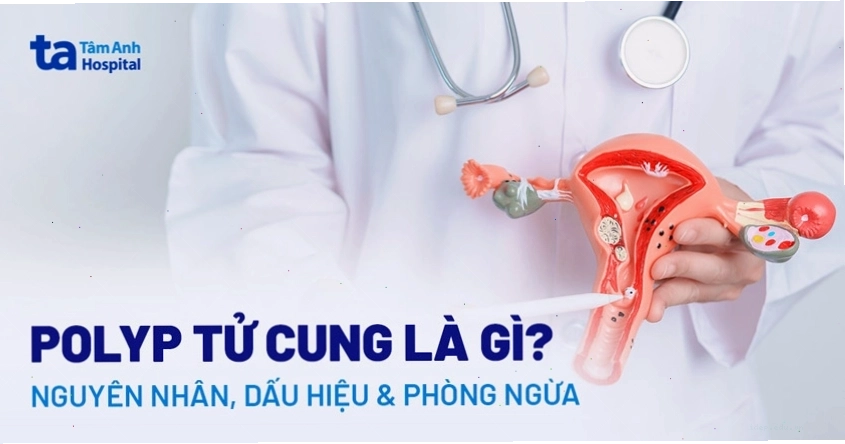 Phẫu thuật cắt bỏ polyp tử cung