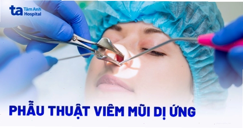 Phẫu thuật có thể là giải pháp cho viêm mũi dị ứng nặng