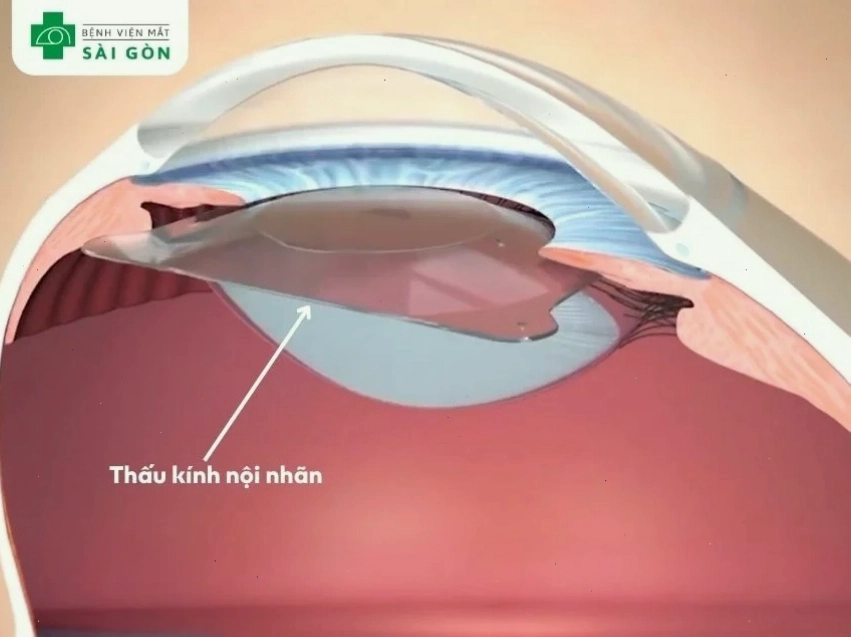 Phẫu thuật mắt cận bằng phương pháp PHAKIC sử dụng thấu kính nội nhãn