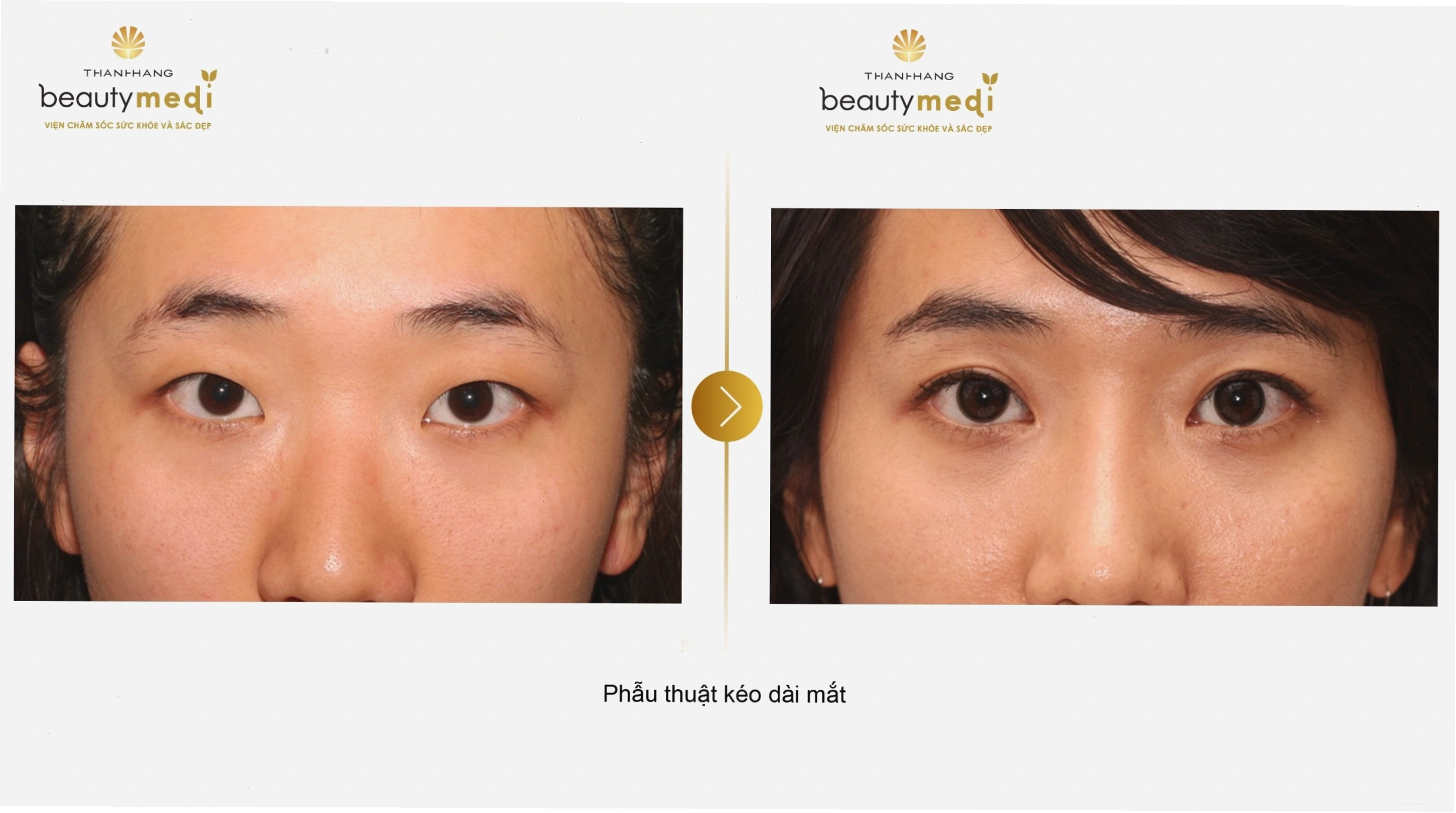 Phẫu thuật mở rộng góc mắt tại Thanh Hằng Beauty Medi