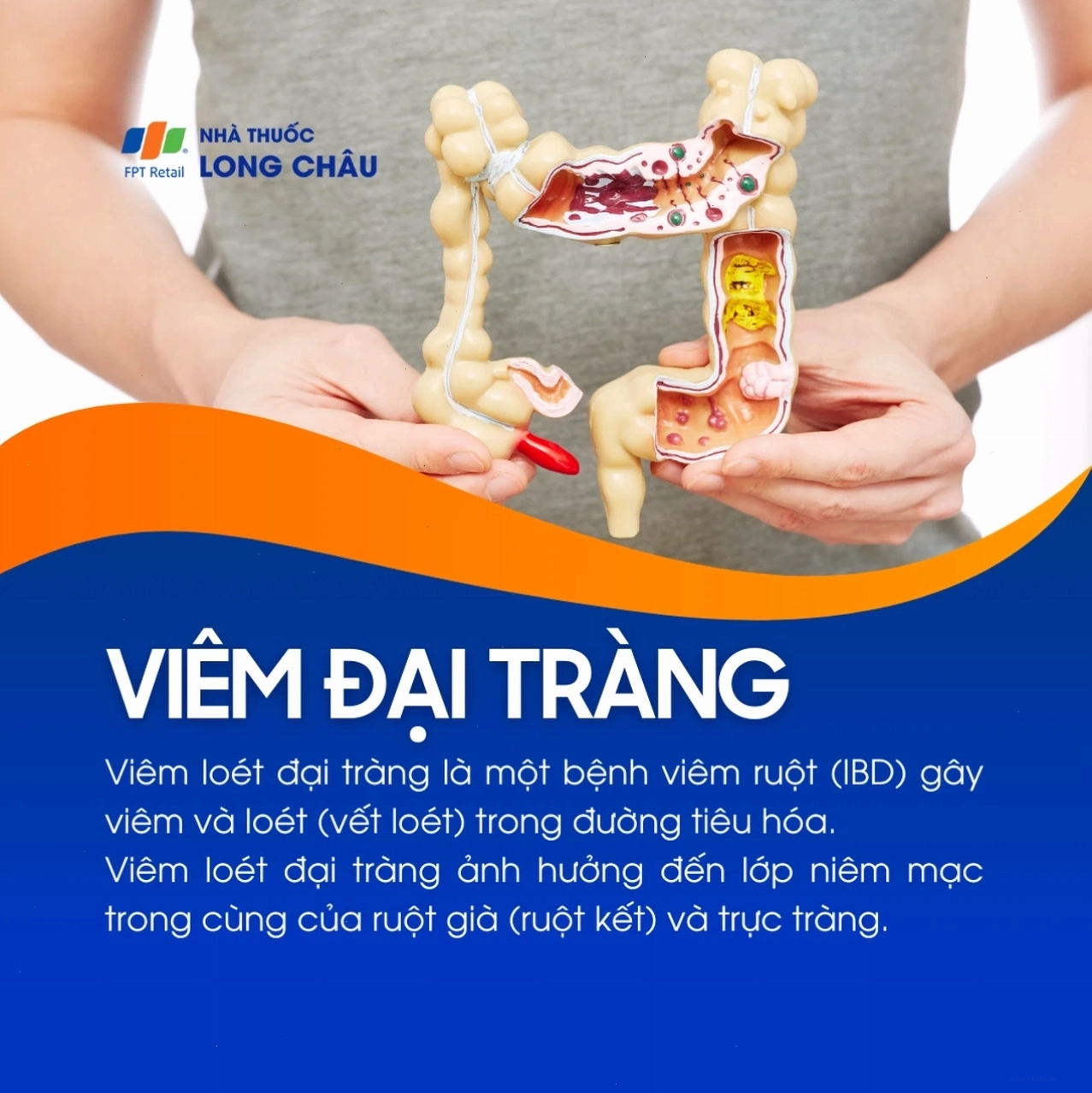 Phòng ngừa viêm đại tràng bằng lối sống lành mạnh