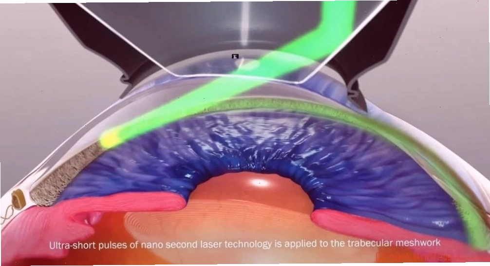 Quang đông xuyên thể mi điều trị Glaucoma