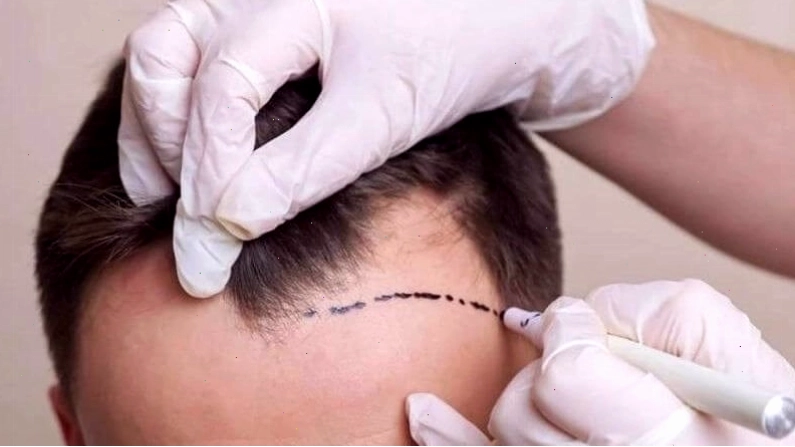 Quy trình cấy tóc tự thân đảm bảo an toàn và hiệu quả