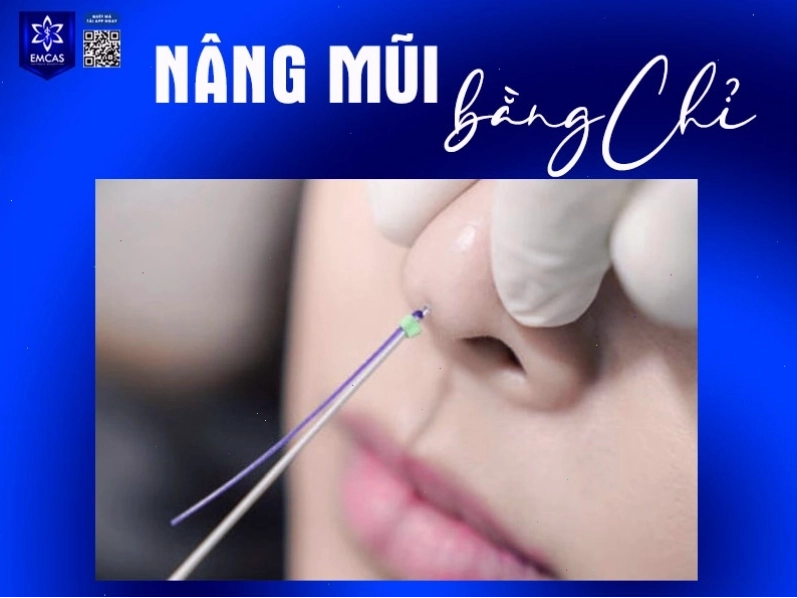 Quy trình thực hiện nâng mũi bằng chỉ chuyên nghiệp