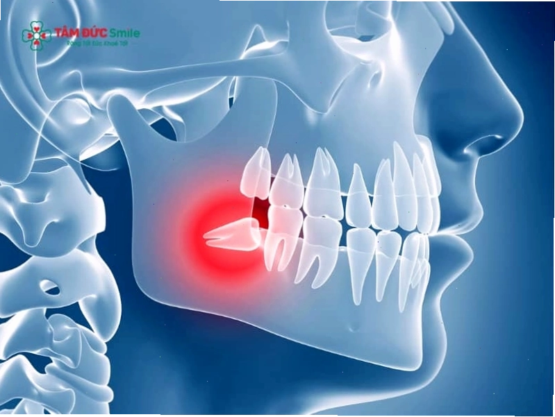 Răng khôn mọc lệch gây đau nhức và ảnh hưởng đến răng lân cận