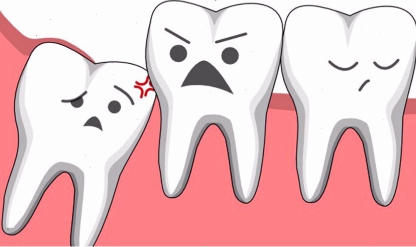Răng khôn và những điều cần biết khi mọc
