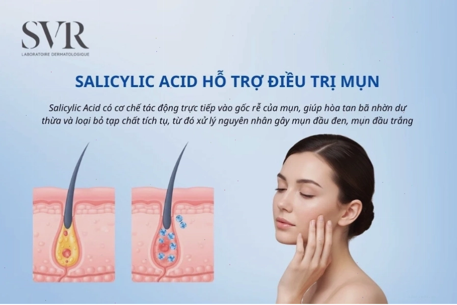 Salicylic Acid hỗ trợ điều trị mụn trứng cá hiệu quả