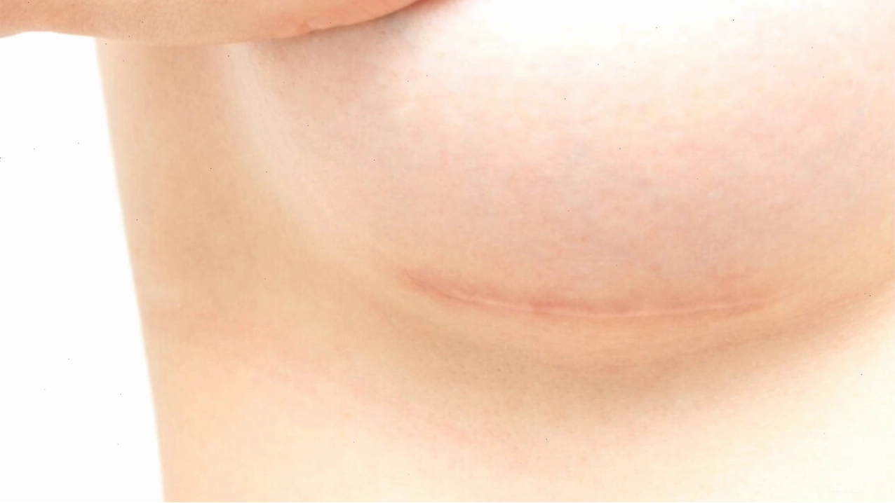 Sẹo mảnh nâng ngực khá khó phát hiện
