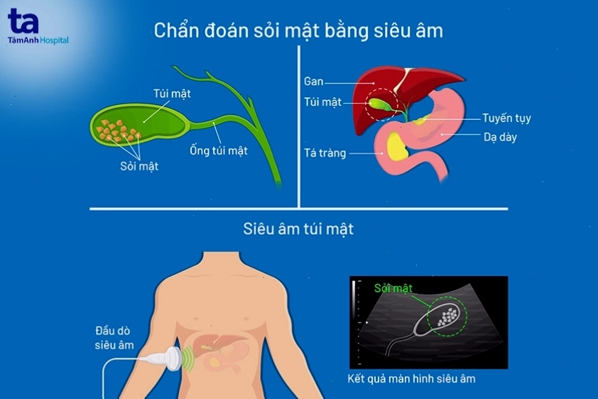 siêu âm sỏi mật