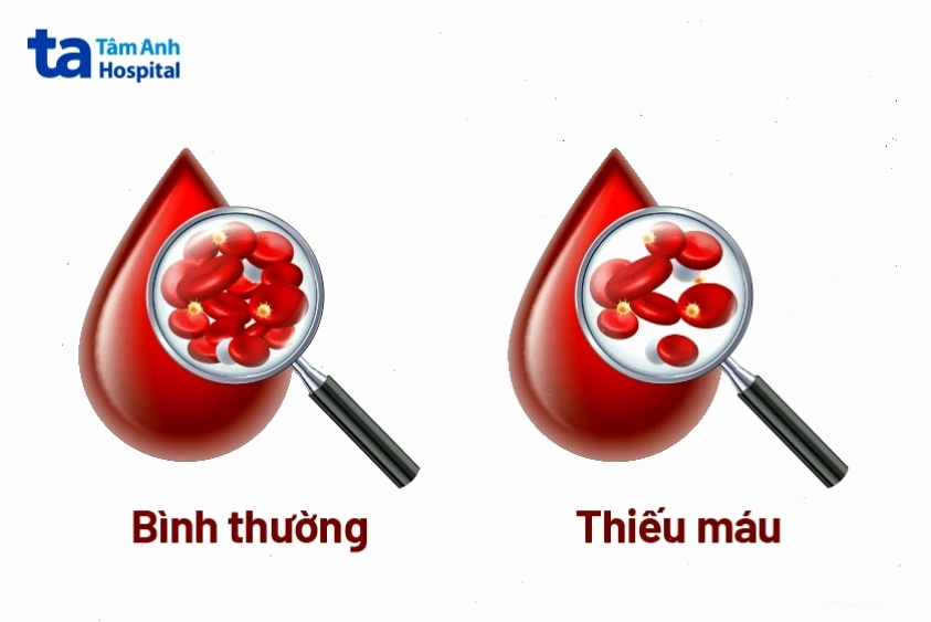 Số lượng hồng cầu thấp