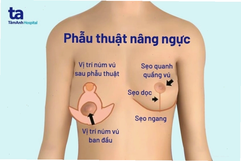 So sánh các phương pháp nâng ngực chảy xệ