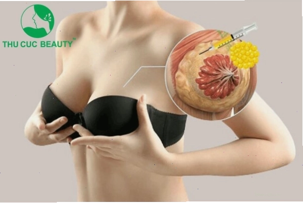 So sánh chi phí nâng ngực bằng mỡ tự thân
