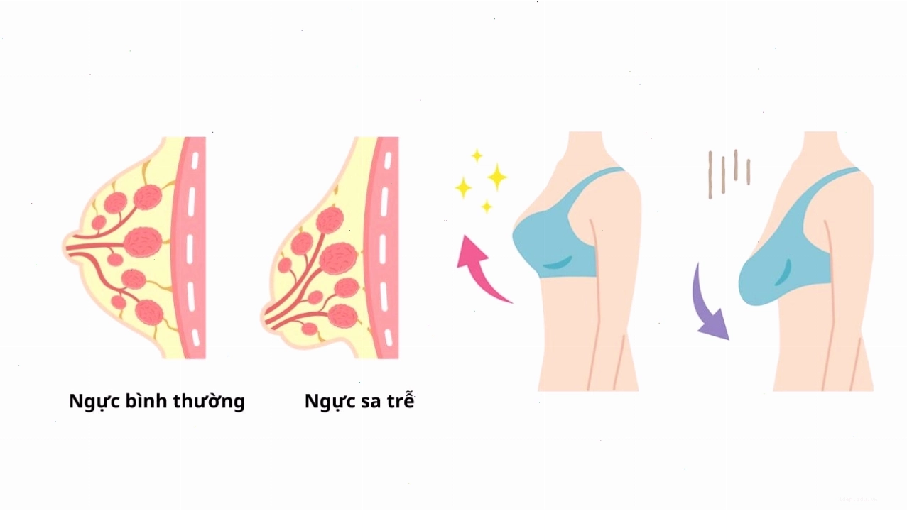 So sánh ngực bình thường và ngực sa trễ