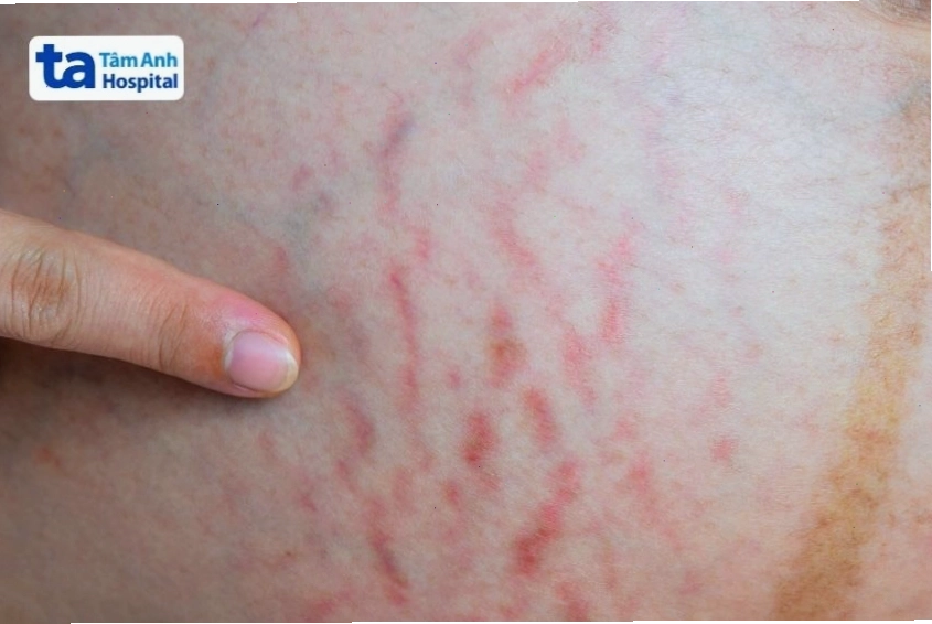 Sự phát triển kích thước của bầu ngực trong thai kỳ, quầng vú sẫm màu hơn