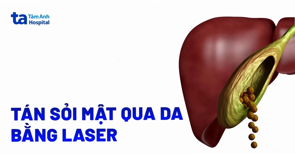 Tán sỏi mật qua da bằng laser: Trường hợp chỉ định và chống chỉ định