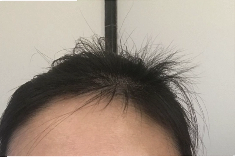 Tóc con mọc lởm chởm ở vùng trán và thái dương